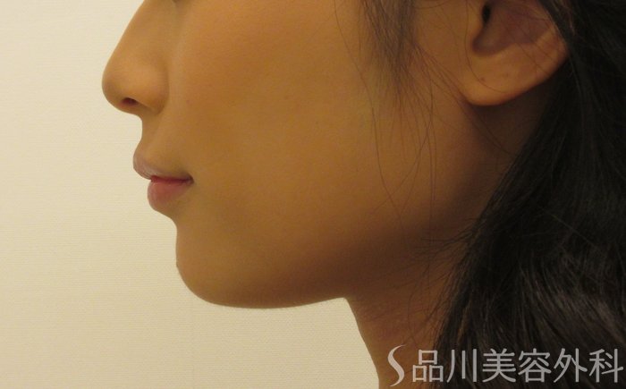 症例NO.71689のBEFORE写真
