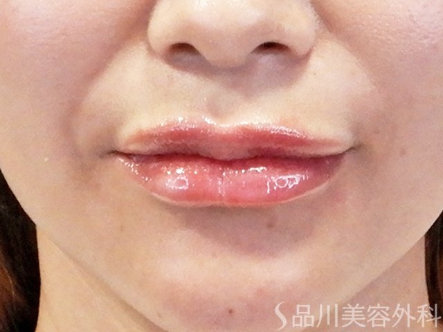 症例NO.67708のAFTER写真