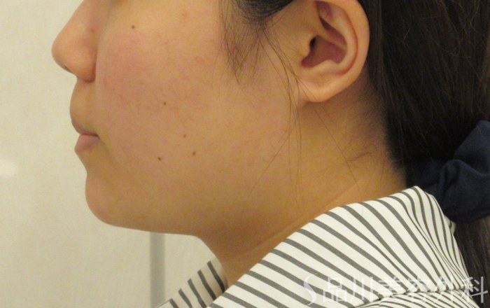 症例NO.71464のBEFORE写真