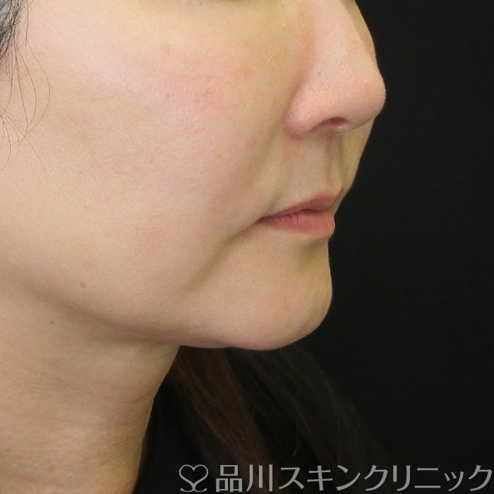 症例NO.74881のBEFORE写真
