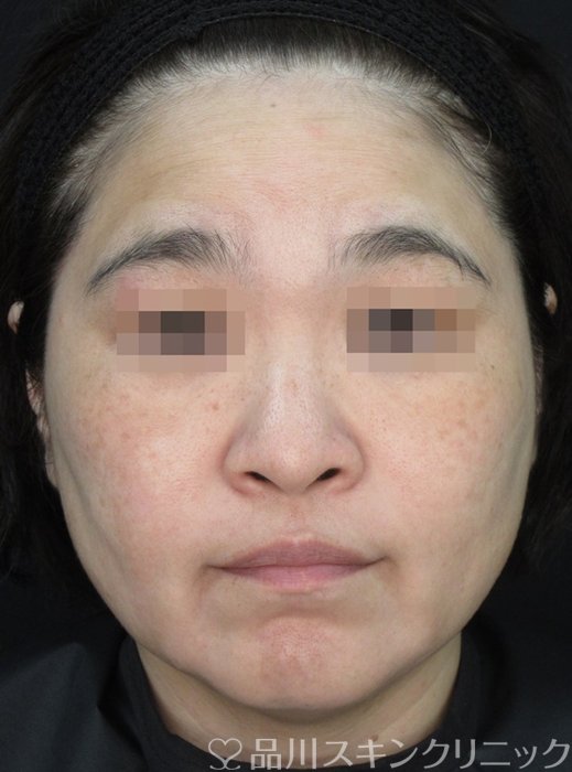 症例NO.72138のBEFORE写真