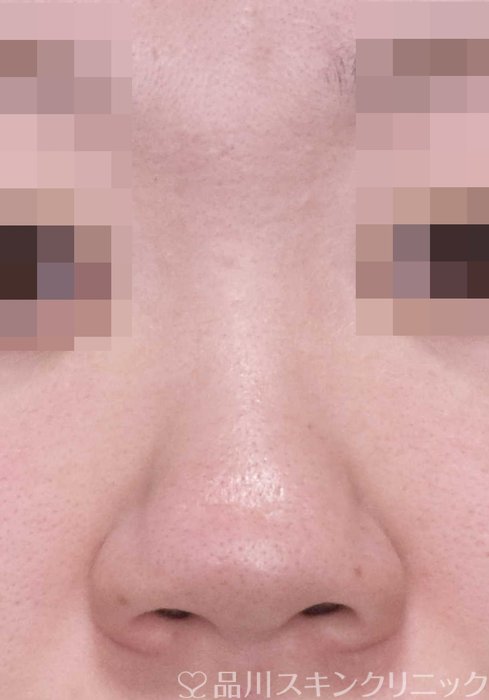 症例NO.65293のBEFORE写真