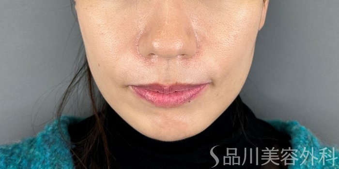 症例NO.70811のBEFORE写真