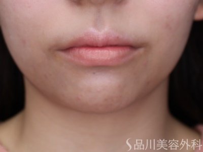 症例NO.65118のBEFORE写真