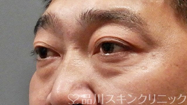 症例NO.64614のBEFORE写真