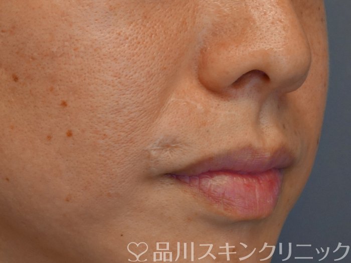 症例NO.72120のBEFORE写真