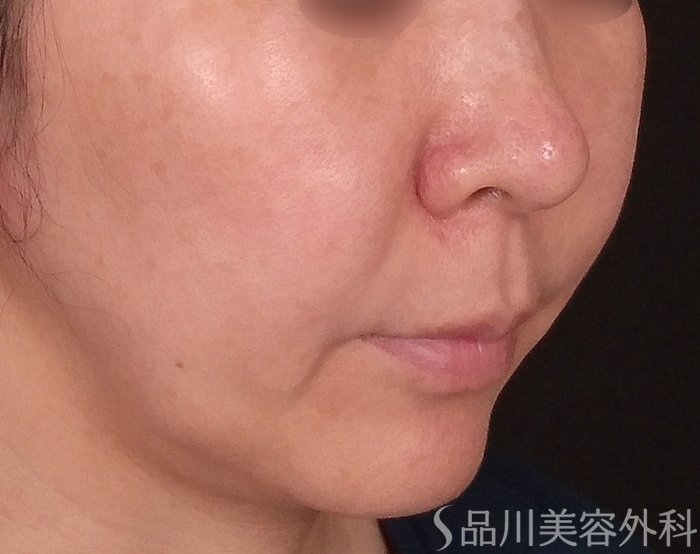 症例NO.70212のBEFORE写真