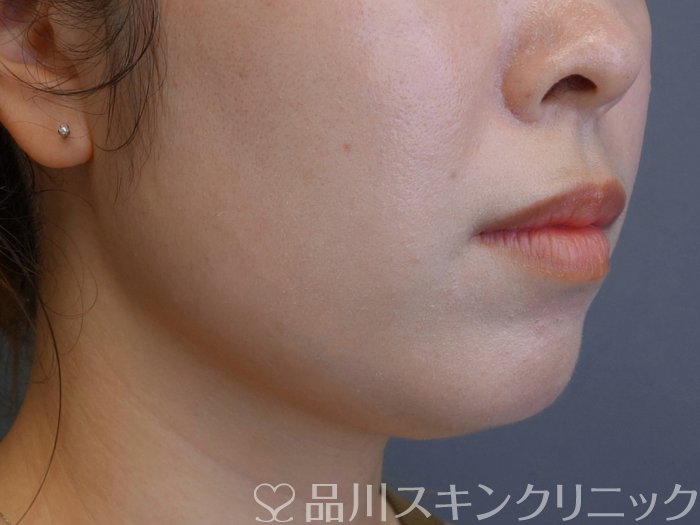 症例NO.74668のBEFORE写真