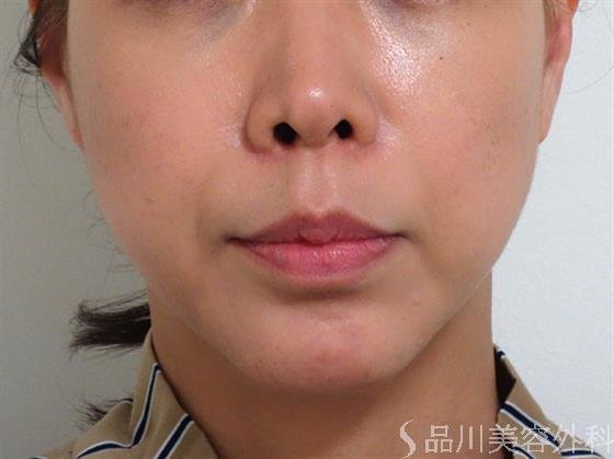 症例NO.36745のAFTER写真