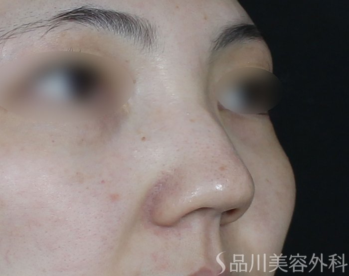 症例NO.65020のBEFORE写真