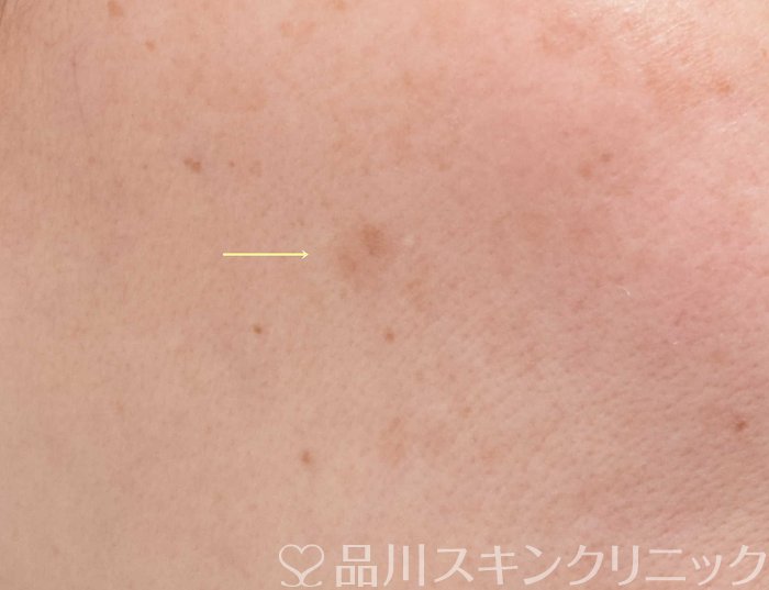 症例NO.69996のBEFORE写真