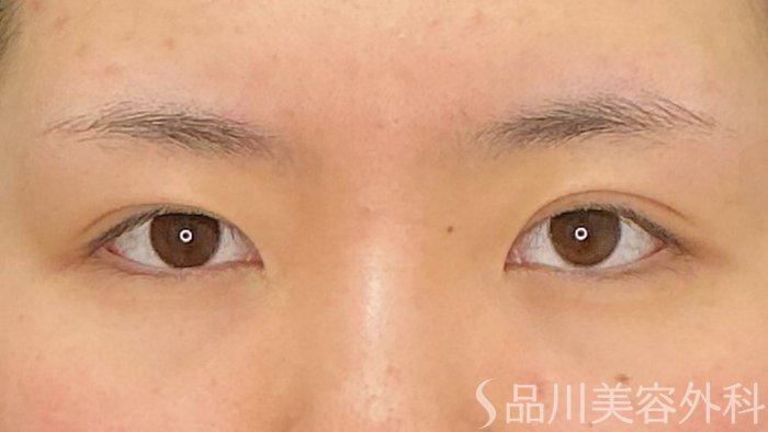 症例NO.72141のAFTER写真