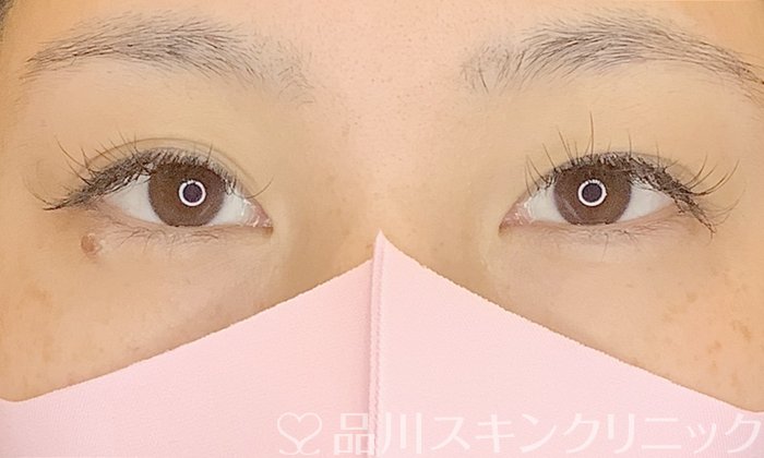 症例NO.70872のBEFORE写真