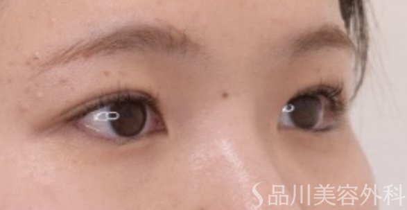 症例NO.67311のAFTER写真
