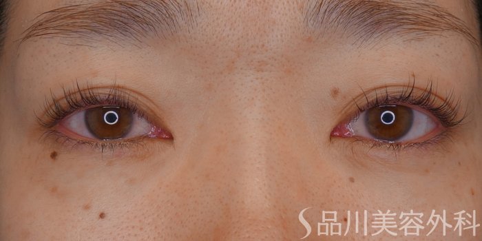 症例NO.73329のAFTER写真