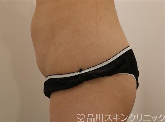 症例NO.44133のAFTER写真