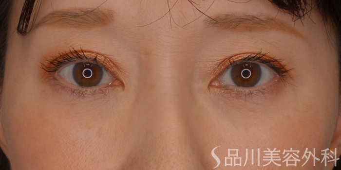 症例NO.75112のAFTER写真