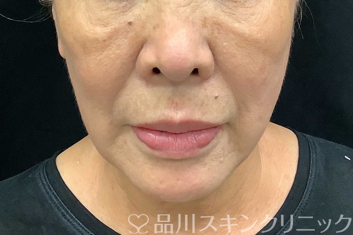 症例NO.69776のAFTER写真