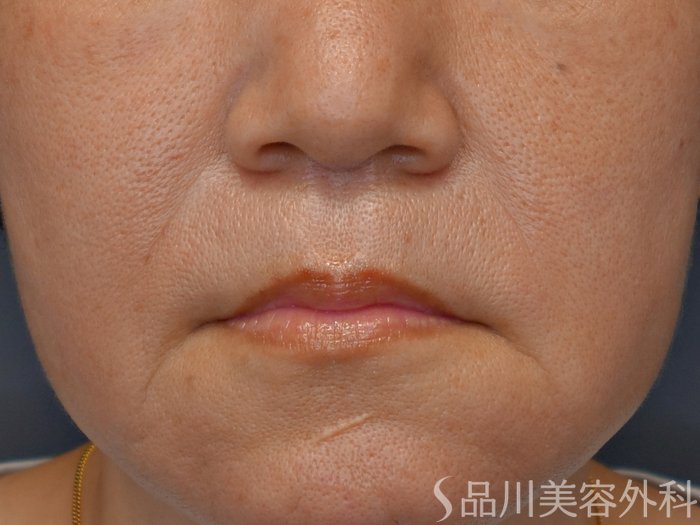 症例NO.71686のBEFORE写真