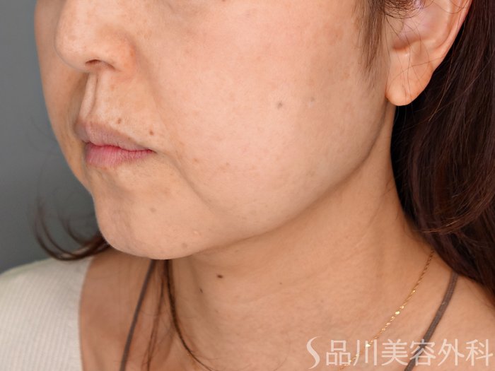 症例NO.70554のBEFORE写真