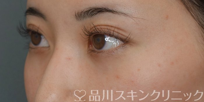 症例NO.74048のAFTER写真