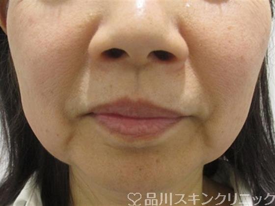 症例NO.34176のBEFORE写真