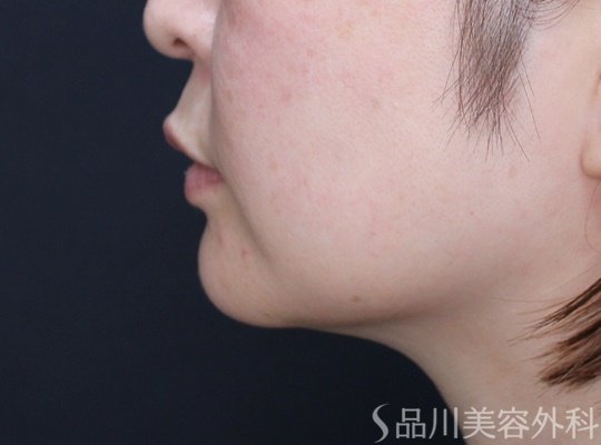 症例NO.69520のBEFORE写真