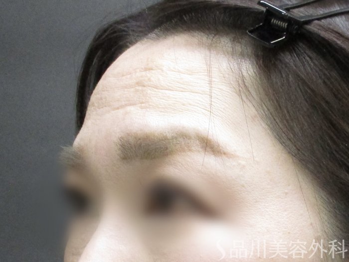 症例NO.65387のBEFORE写真