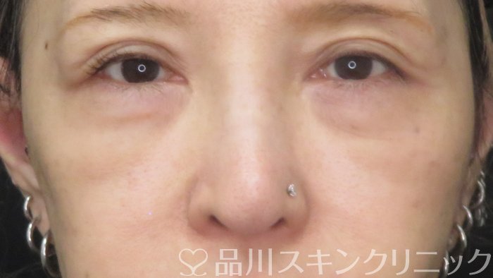 症例NO.72715のBEFORE写真