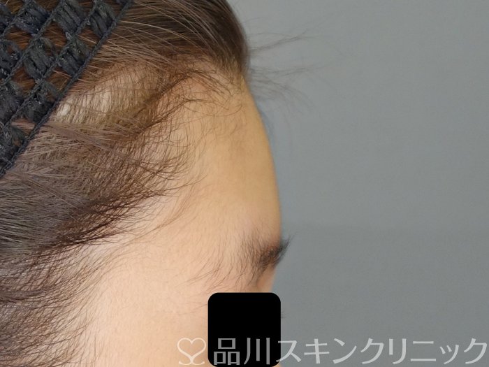 症例NO.70829のBEFORE写真