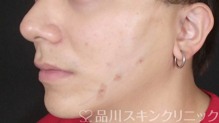 症例NO.71366のAFTER写真