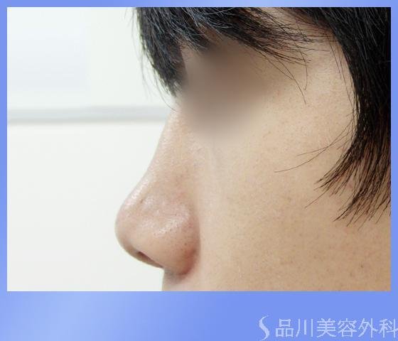 症例NO.1146のAFTER写真
