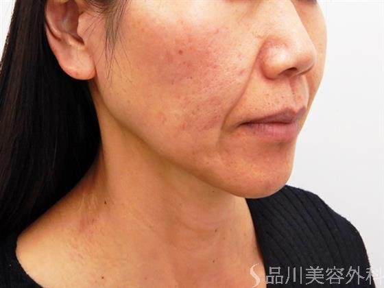 症例NO.53497のBEFORE写真