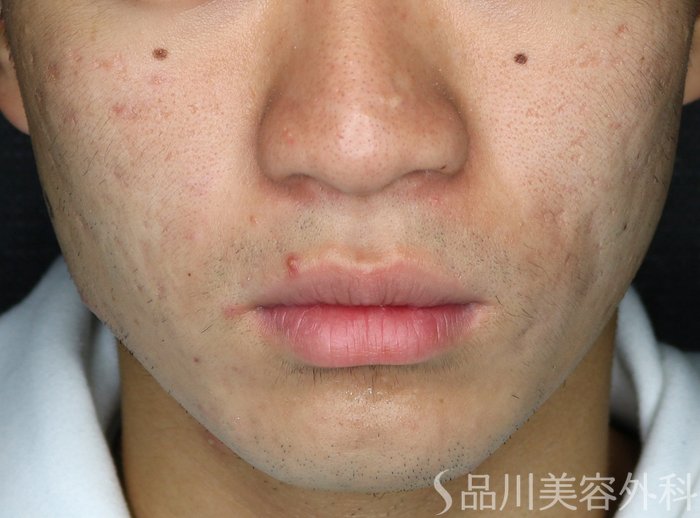 症例NO.70160のAFTER写真