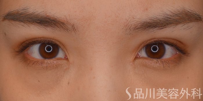 症例NO.75357のAFTER写真