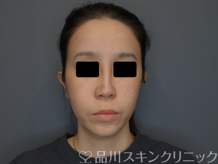 症例NO.75051のBEFORE写真