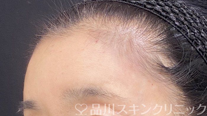 症例NO.74401のAFTER写真