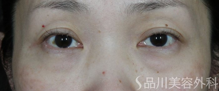 症例NO.65563のBEFORE写真