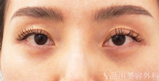 症例NO.52570のAFTER写真