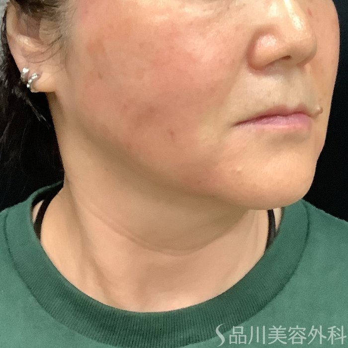症例NO.75332のAFTER写真