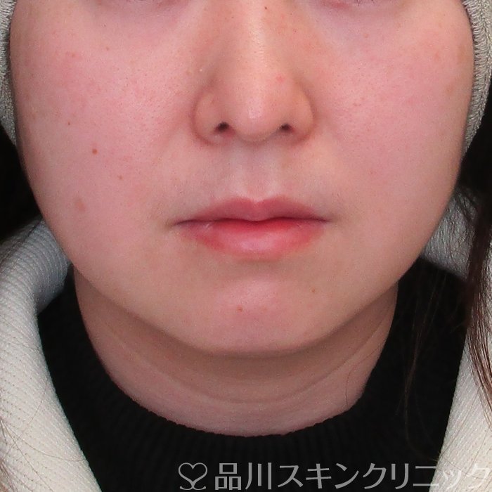 症例NO.73987のBEFORE写真