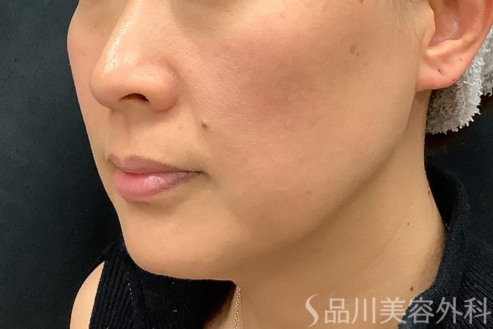 症例NO.73311のBEFORE写真