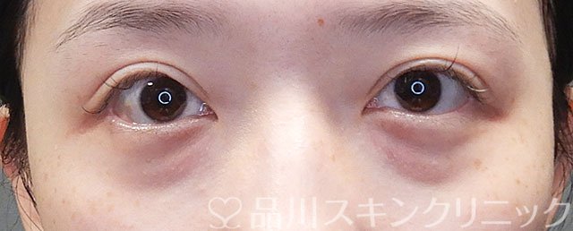 症例NO.71913のBEFORE写真