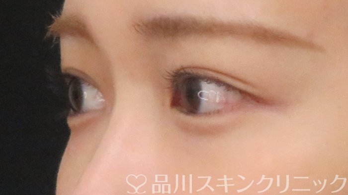 症例NO.69942のBEFORE写真