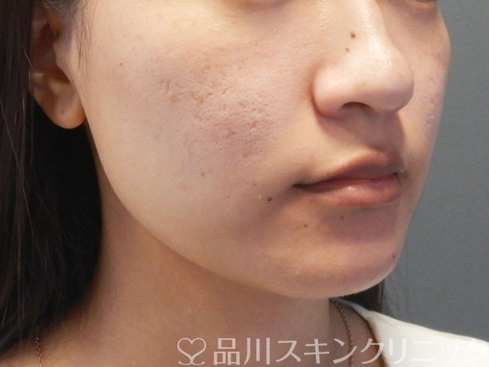 症例NO.73327のBEFORE写真