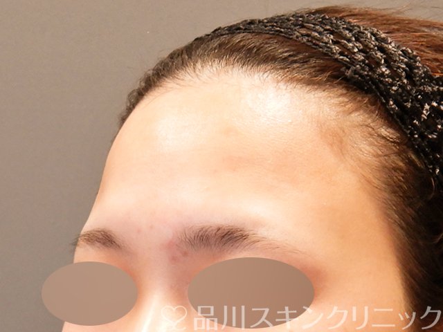 症例NO.69953のBEFORE写真