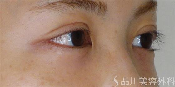 症例NO.53161のAFTER写真