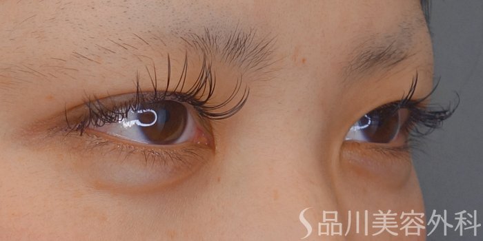 症例NO.69308のBEFORE写真