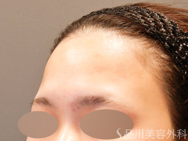 症例NO.69953のBEFORE写真