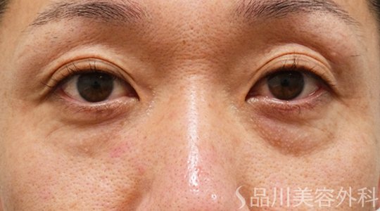 症例NO.71142のBEFORE写真